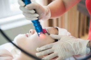 điều trị nám bằng laser