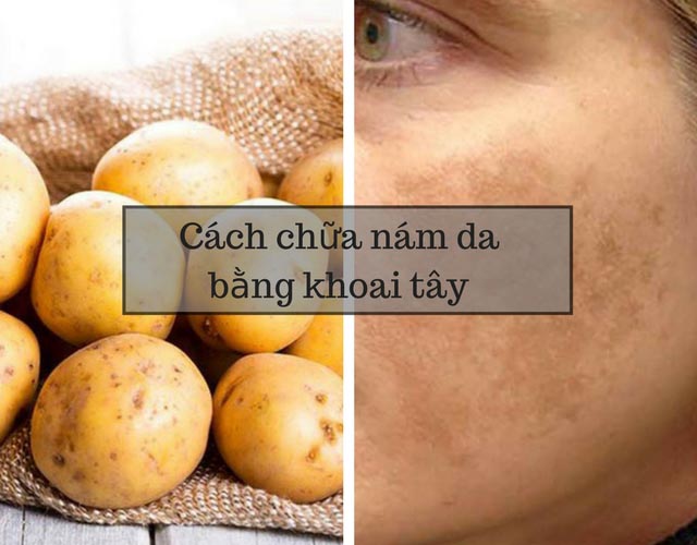 trị nám da bằng khoai tây