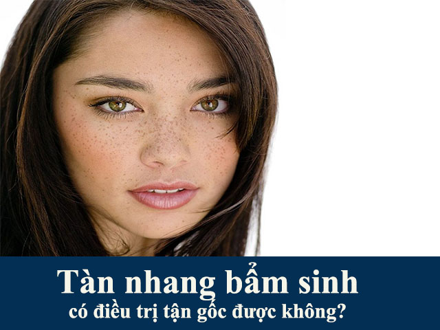 Tàn nhang bẩm sinh có điều trị tận gốc được không?