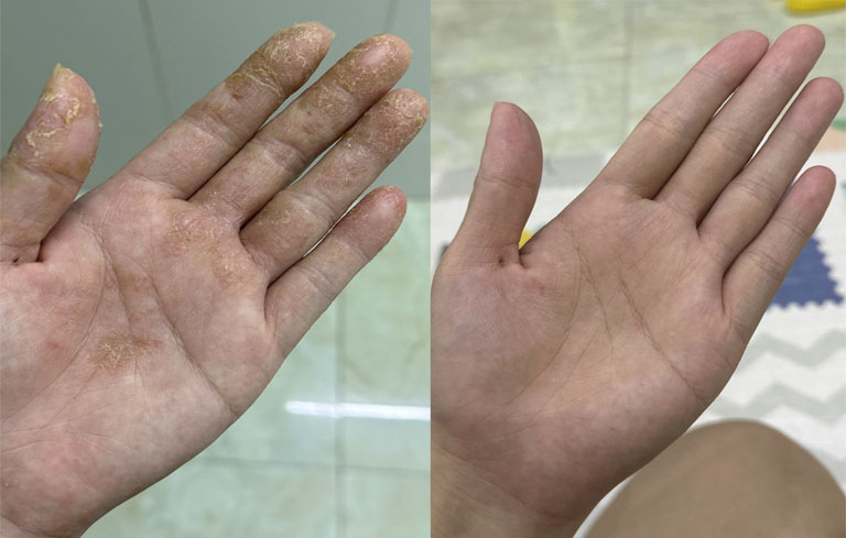 Trước và sau khi dùng thuốc