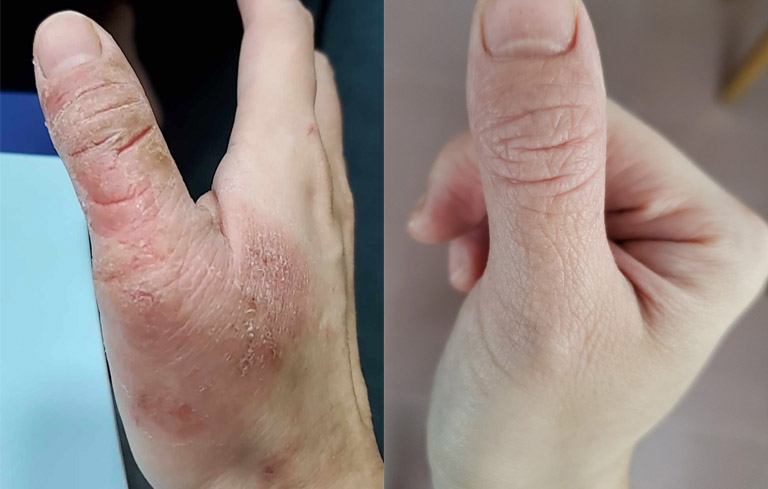 Hình ảnh trước và sau khi dùng thuốc