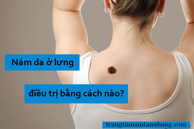 Nám da ở lưng điều trị bằng phương pháp nào?