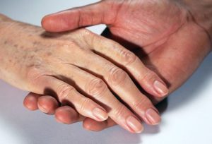 Nám da ở mu bàn tay