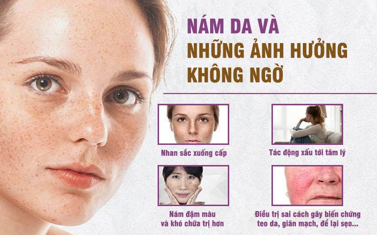 Nám da tàn nhang gây ra những ảnh hưởng xấu đối với chị em phụ nữ