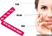 Vị trí nào trên mặt dễ bị nám và tàn nhang nhất?