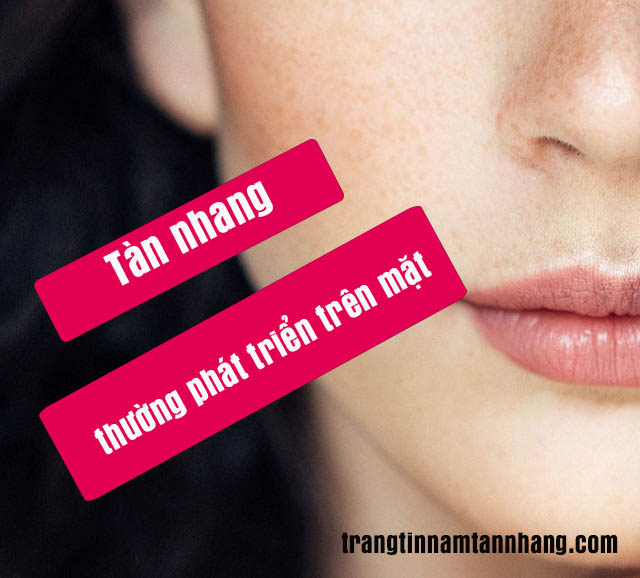 Nám da, tàn nhang thường phát triển trên mặt