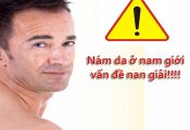 Cách trị nám da mặt ở nam giới
