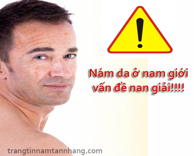 Cách trị nám da mặt ở nam giới