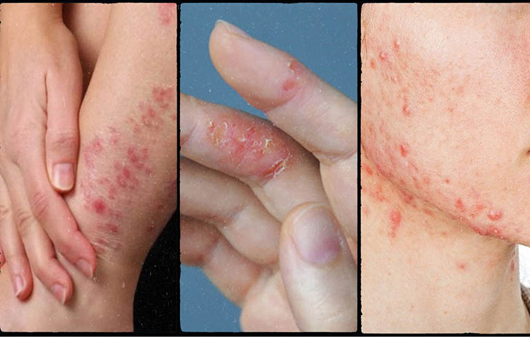 Biểu hiện viêm da cơ địa