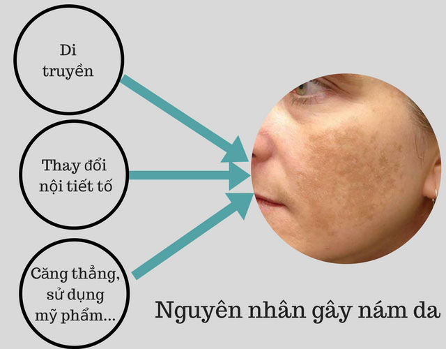 nguyên nhân gây nám da mặt thường gặp