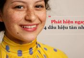 Dấu hiệu nhận biết da mặt bị tàn nhang