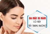 Da mặt bị nám có nên tẩy trang không?