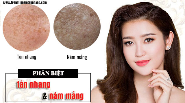 Cách phân biệt nám mảng và tàn nhang