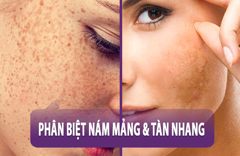 Nám mảng và tàn nhang có một số điểm tương đồng khiến không ít người nhầm lẫn