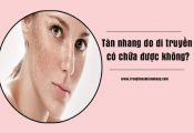 Tàn nhang do di truyền có chữa được không?