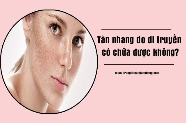 Tàn nhang do di truyền có chữa được không?