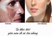 Tàn nhang và nám da khác nhau như thế nào?