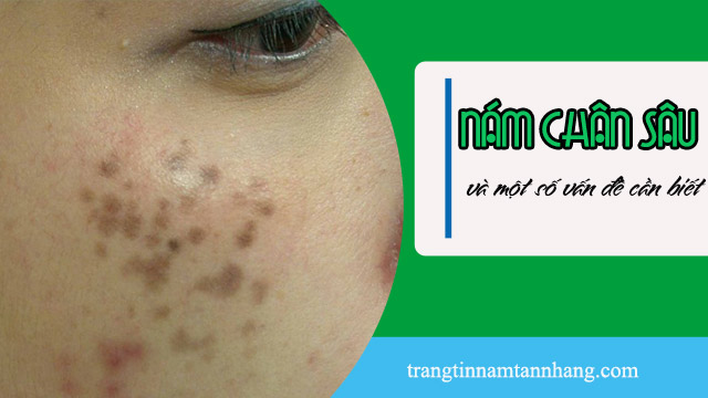 Nám chân sâu là gì ? Có cách nào trị dứt điểm không ?