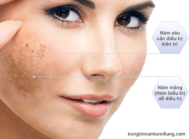 Nám chân sâu là gì ? Có cách nào trị dứt điểm không ?