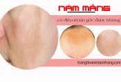 Nám mảng có điều trị tận gốc được không?