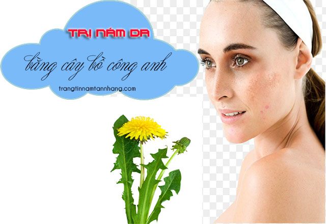 Trị nám da bằng bồ công anh