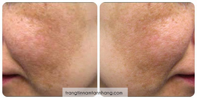 Phân biệt nám chân sâu và nám thường