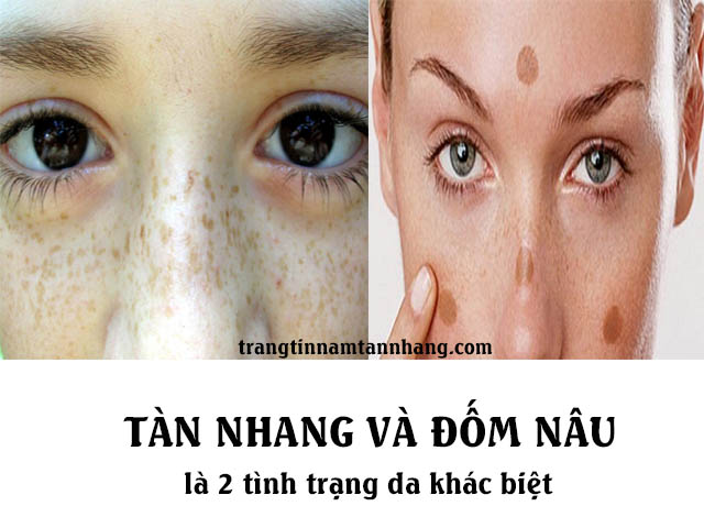 Tàn nhang và đốm nâu có giống nhau không?