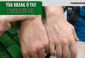 Trị tàn nhang ở tay