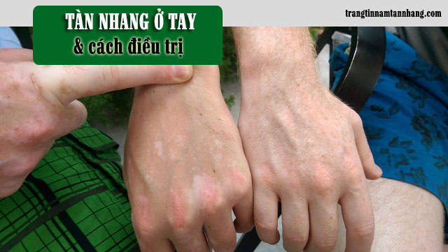 Trị tàn nhang ở tay