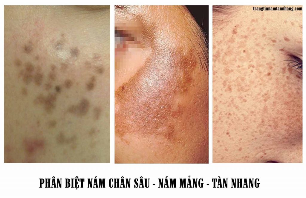 Phân biệt nám mảng - nám chân sâu - tàn nhang đơn giản