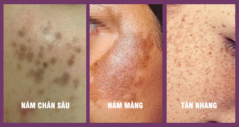 Phân biệt nám mảng - nám chân sâu - tàn nhang đơn giản mà chị em không nên bỏ lỡ