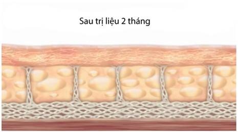 Kết quả sau 2 tháng sử dụng công nghệ trẻ hóa da Hifu