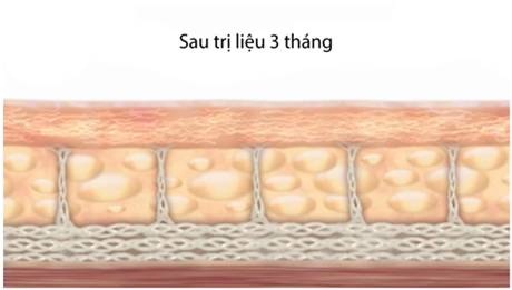 Kết quả tuyệt vời trên làn da sau 3 tháng bằng công nghệ trẻ hoá Hifu