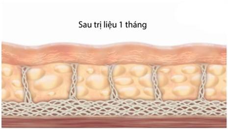 Kết quả sau 1 tháng áp dụng công nghệ trẻ hóa da Hifu