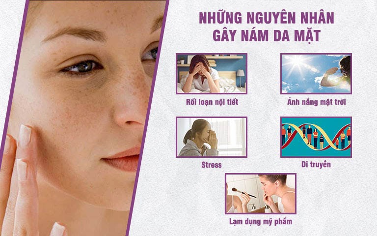 Nám da mặt khiến làn da thâm sạm, kém thẩm mỹ