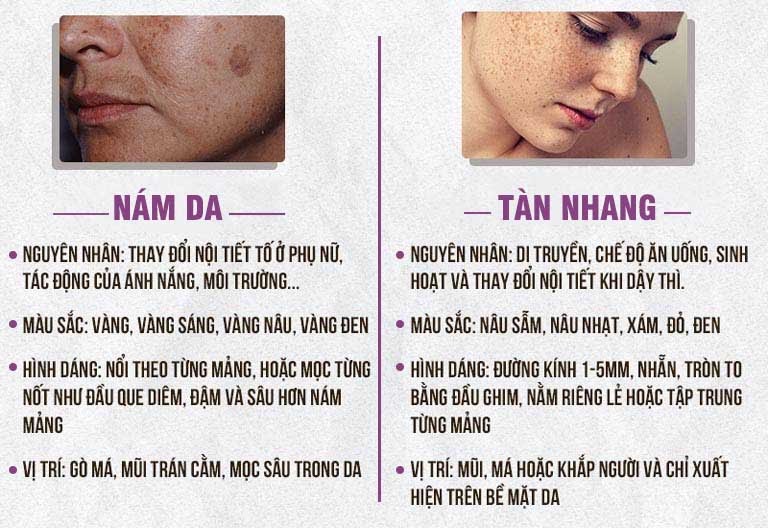 Phân biệt nám da, tàn nhang thông qua các đặc điểm cụ thể