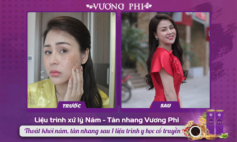 Diễn viên Lương Thu Trang đã lấy lại được sự tự tin sau khi thoát khỏi nám, tàn nhang nhờ liệu trình thảo dược Vương Phi