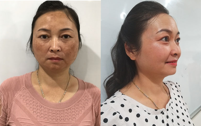 Làn da trước và sau khi dùng Vương Phi của cô Tạ Thị Vân