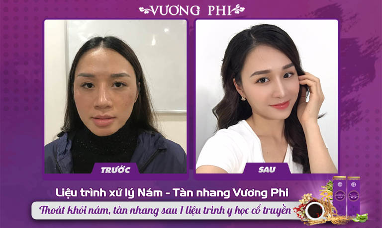 Khách hàng Thu Hưởng đẩy lùi nám tàn nhang sau sinh nhờ Vương Phi