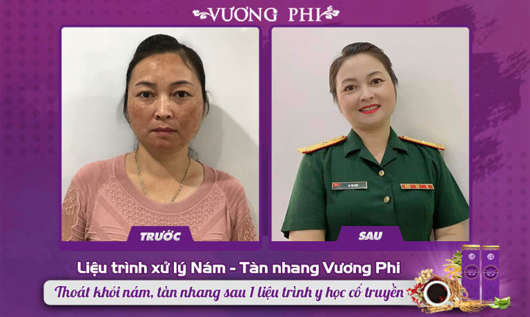 Nữ quân nhân 47 tuổi cải thiện 80% nám, tàn nhang sau 2 tháng