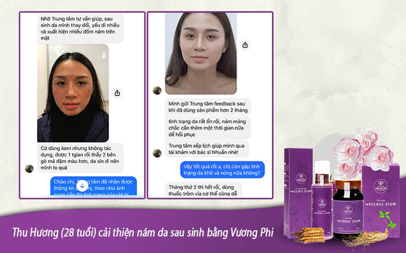Chị Thu Hương cải thiện nám đốm, nám mảng sau sinh với một liệu trình ngắn sử dụng Vương Phi