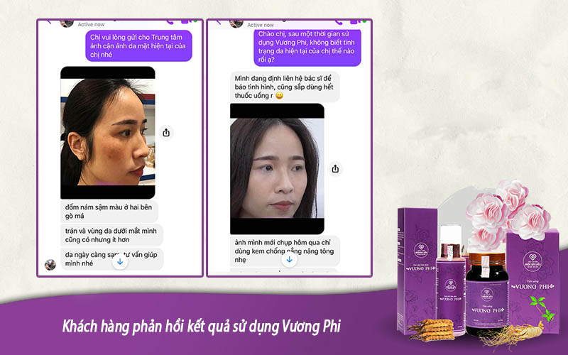 Khách hàng “tạm biệt” nám mảng lâu năm nhờ sự trợ giúp của bộ sản phẩm Vương Phi