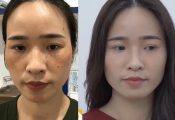 Đẩy lùi 80% nám tàn nhang chỉ sau 2 tháng với liệu trình thảo dược Vương Phi
