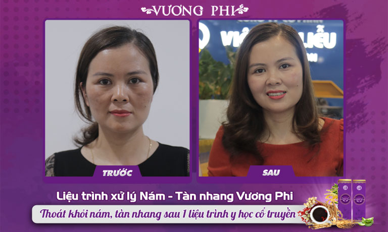 Chị Mơ và kết quả sau hơn 4 tháng dùng Vương Phi