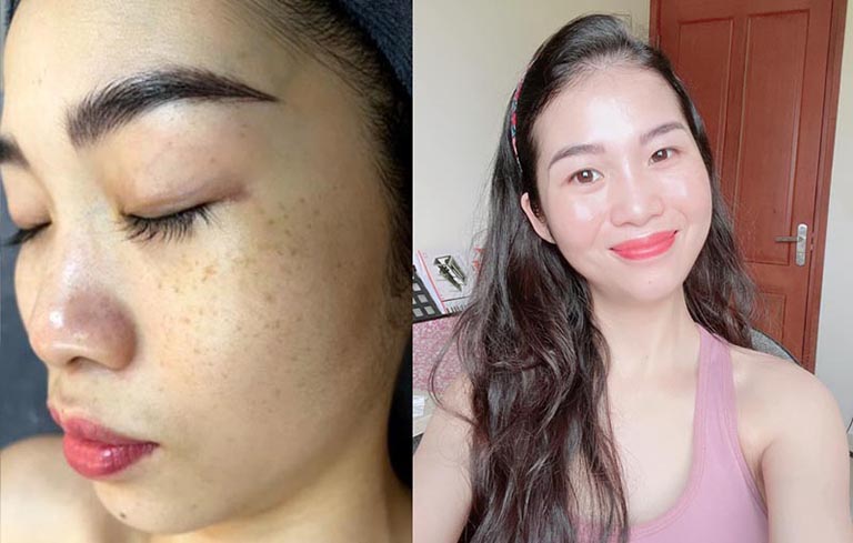 Hình ảnh trước và sau khi dùng Vương Phi của chị Trang