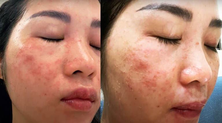Làn da của chị Trang sau khi áp dụng laser nhưng sai cách khiến da tổn thương, tấy đỏ