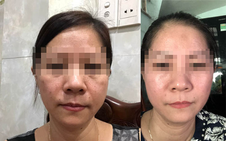 Làn da của chị A.V trước và sau khi dùng Liệu trình Vương Phi được Trung tâm Da liễu Đông y Việt Nam cung cấp