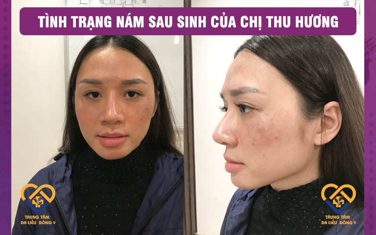 Tình trạng nám sau sinh của chị Thu Hương