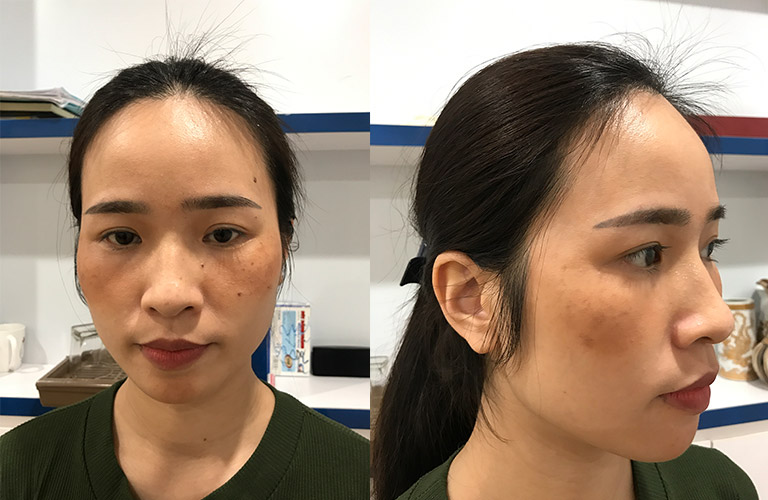 Nám lâu năm, nám do nội tiết tố sẽ khó xử lý với các phương pháp công nghệ cao