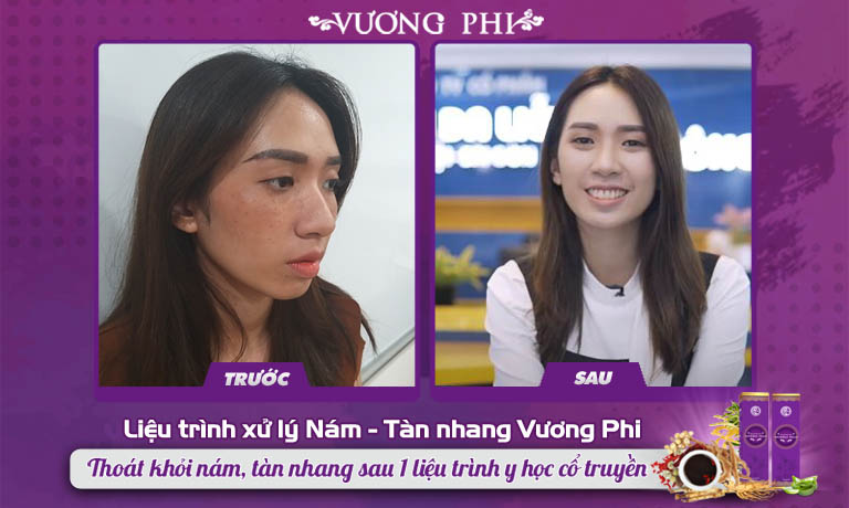 Sự thay đổi lớn TRƯỚC - SAU 2 tháng Thanh Vân sử dụng Vương Phi